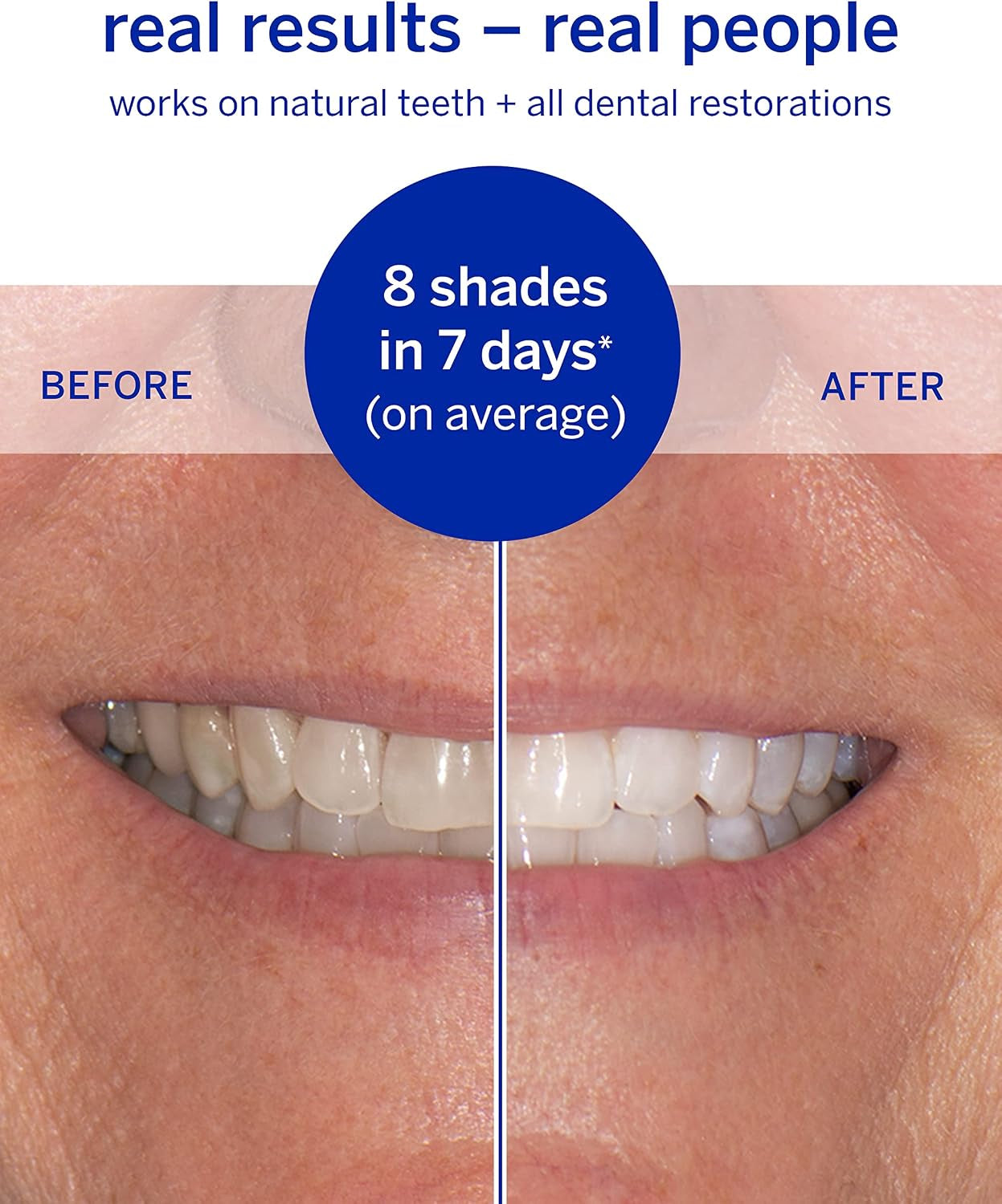 Superstrips & Professional Whitening System Kit, Dissolving Teeth Whitening Strips plus Toothpaste & Accelerator, Calprox®, Enamel Safe for Sensitive Teeth